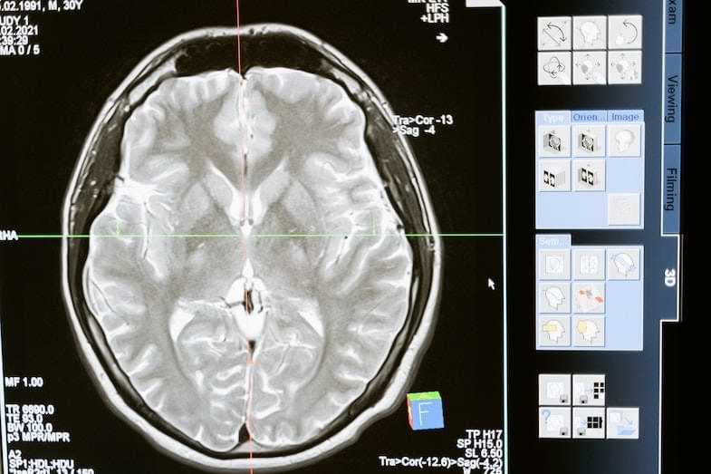 effet du cannabis sur le cerveau | Justbob